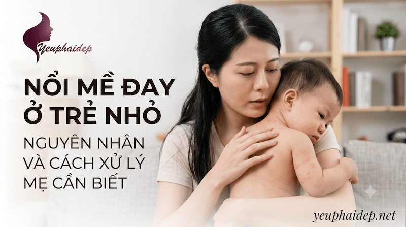Nổi Mề Đay Ở Trẻ Nhỏ: Nguyên Nhân Và Cách Xử Lý Mẹ Cần Biết