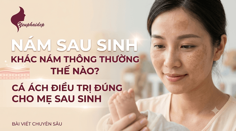 Nám Sau Sinh Khác Nám Thông Thường Thế Nào? Cách Điều Trị Đúng Cho Mẹ Sau Sinh
