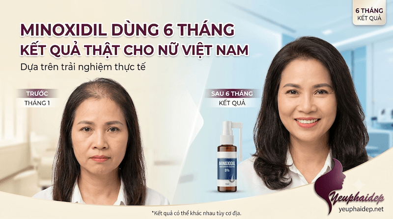 Minoxidil Dùng 6 Tháng - Kết Quả Thật Cho Nữ Việt Nam