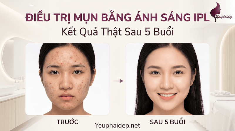 Điều Trị Mụn Bằng Ánh Sáng IPL — Kết Quả Thật Sau 5 Buổi