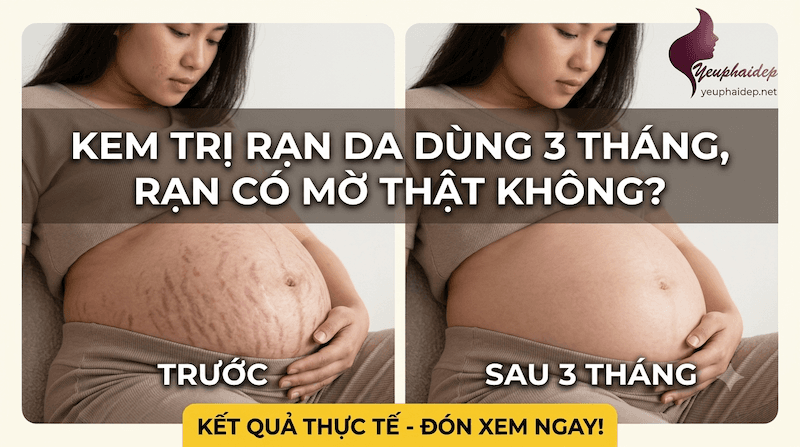Kem trị rạn da dùng 3 tháng, rạn có mờ thật không?