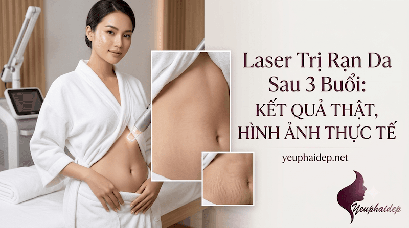 Laser Trị Rạn Da Sau 3 Buổi: Kết Quả Thật, Hình Ảnh Thực Tế