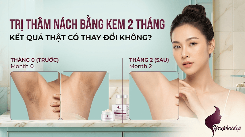 Trị Thâm Nách Bằng Kem 2 Tháng: Kết Quả Thật Có Thay Đổi Không?